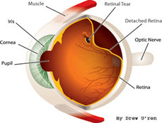 Distacco di retina