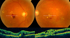 Immagine del fondo oculare di entrambi gli occhi dello stesso 
	paziente