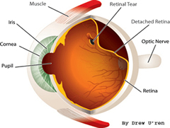 Distacco di retina per rottura periferica