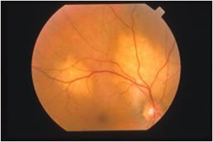 Metastasi Oculari