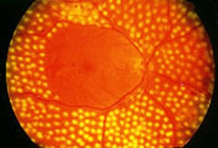 Applicazione laser in corso di retinopatia diabetica proliferante