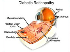 Eye Diseases: Diabetic Retinopathy
