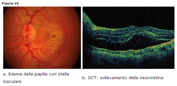 Neuroretiniti