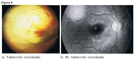 TBC retinica