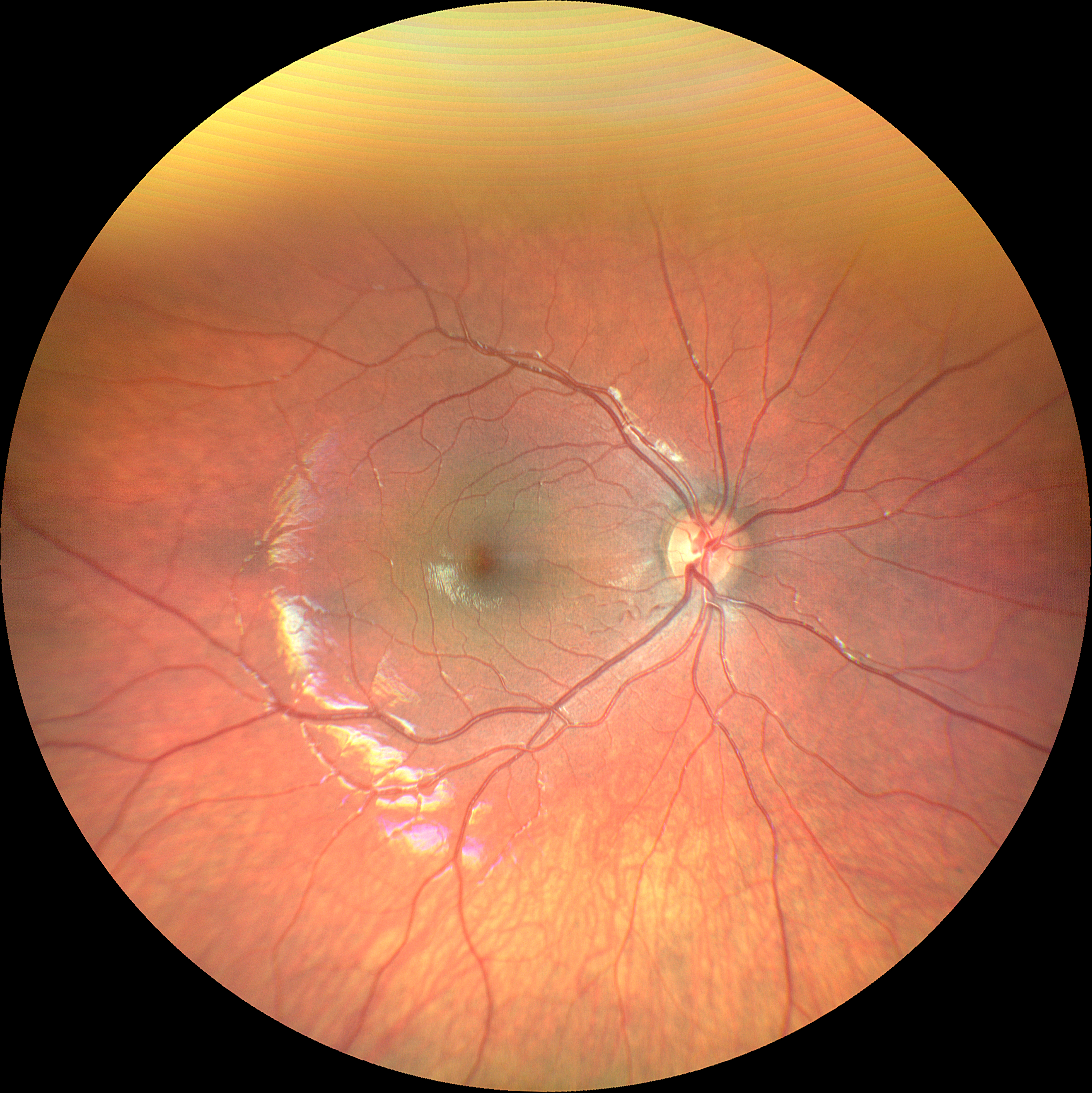 Imaging retinico ad ampio campo in bimbo di 12 mesi