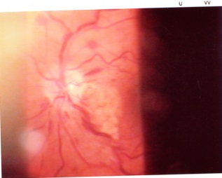 Recupero Visus dopo occlusione vena centrale retina