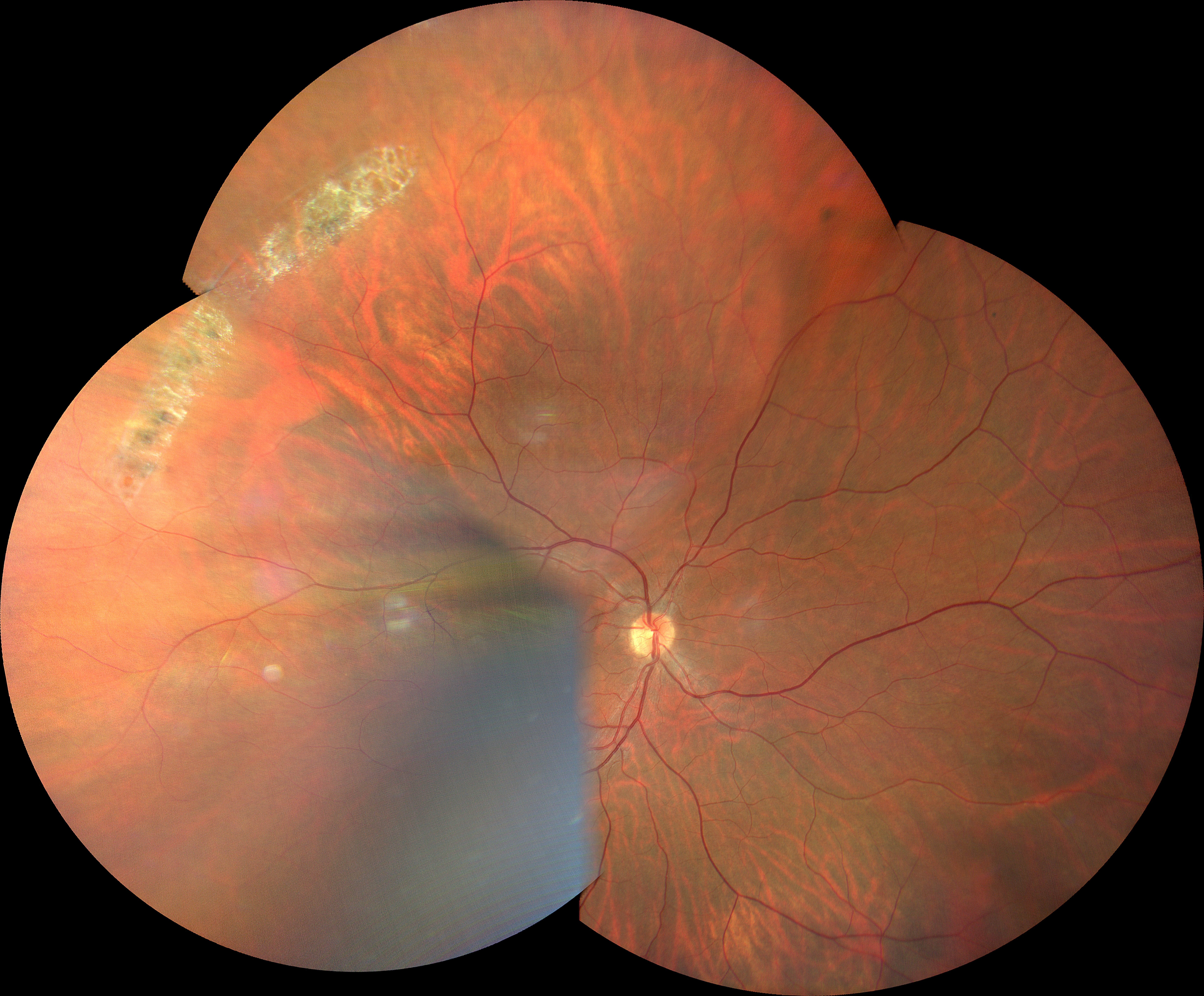 Degenerazione retinica reticolata