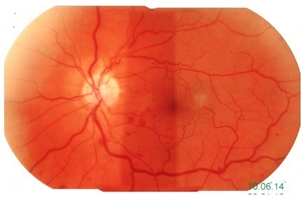 Occlusione parziale vena retinica temporale