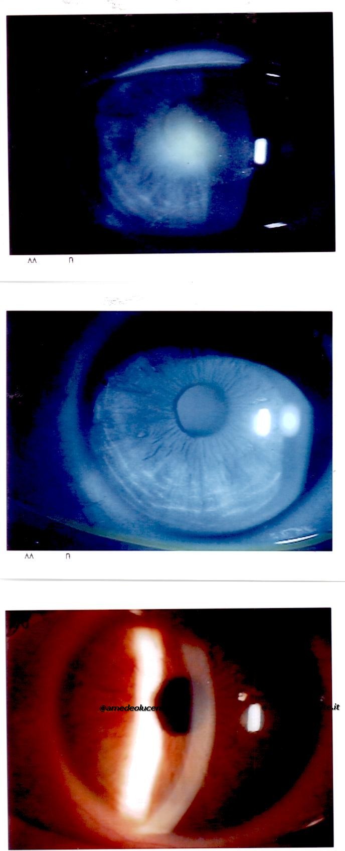 Abrasione epiteliale corneale da lente a contatto