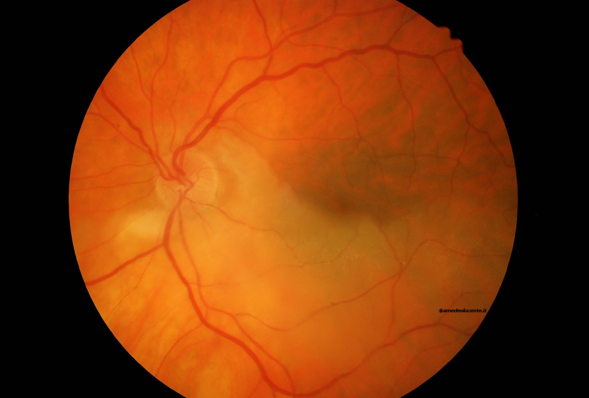 Occlusione emiciclica arteria centrale retina