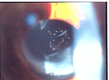 Lesioni da Yag laser sulla IOL per secondaria