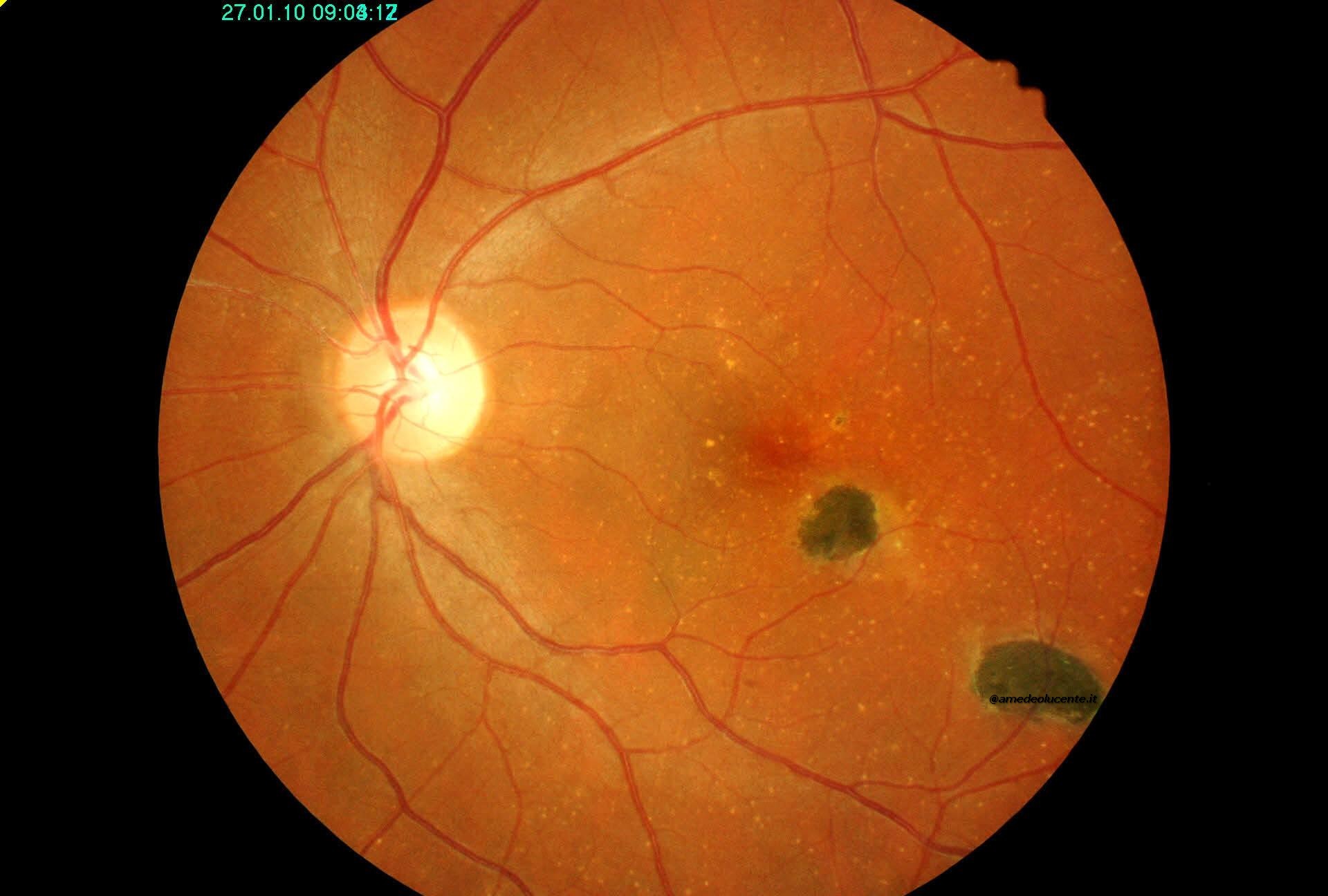 Cicatrici retiniche congenite similtoxo